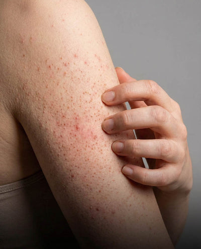 Queratosis pilar